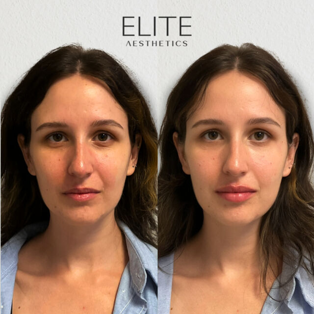 Eye & lip filler duo ✨  Another perfect example of harmonizing the face in a subtle but impactful way.⁣
For this beautiful client we used dermal filler to: 
✦ Smooth and brighten her under eye area
✦ Enhance the contour and natural shape of her lips

She looks super refreshed and well rested while still looking like herself 😌 We love it! 

#dermalfiller#antiageing#lipsbeforeandafter#beforeandafterlips#lipfiller#nycinjector