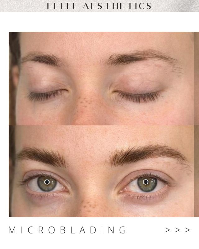 Transforming brows, one stroke at a time 💫

Our microblading artist @nayeontattoo gave her client—
+ texture
+ lift
+ fullness 

TO BOOK:
Call/text our office at 212-647-1930

#microblading#microbladingnyc#browsbeforeandafter#eyebrowshaping#browartist#browartistry