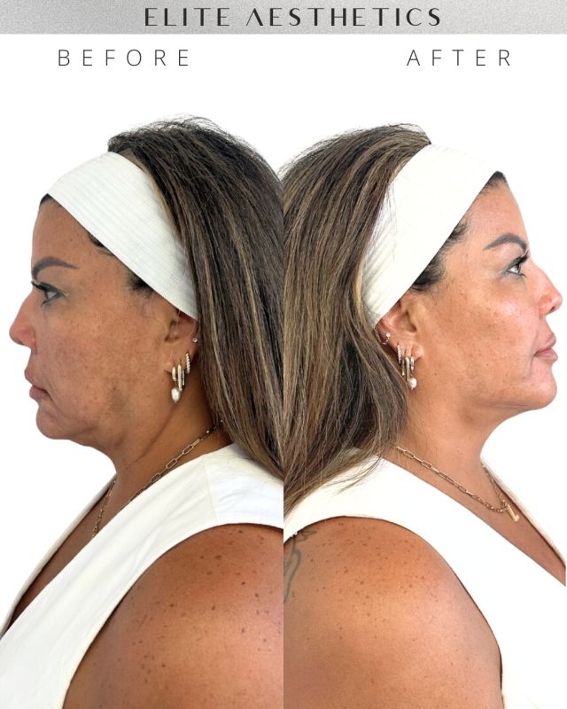 The ultimate secret sauce for achieving that perfectly balanced, tight, glowy face… SCULPTRA!!

Swipe ▶️ to find out how we used Sculptra to achieve this gorgeous and snatched result.

As we age, the body’s collagen production decreases. The loss of collagen will in time lead to loose, saggy skin and the formation of facial wrinkles and folds.

Sculptra® activates the skin’s ability to produce collagen, restoring the skin’s structure, renewing its natural firmness, and replacing lost volume in a gradual and long-lasting way.

#sculptra#sculptrabeforeandafter#sculptranyc #nycbotox#nycfiller#nycinjector#nycsculptra#botoxnyc