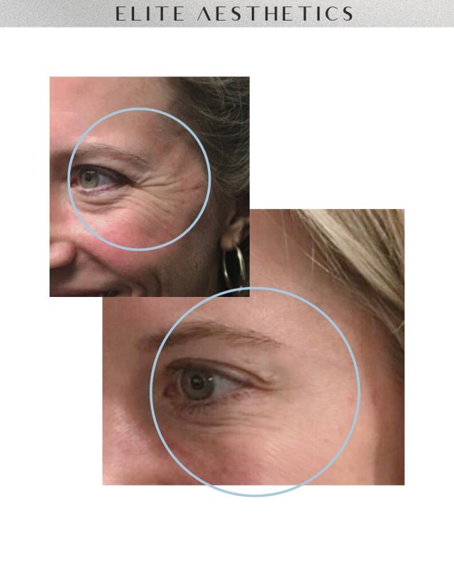 Smoother, youthful eyes ⚡️👁️‍🗨️ via, Botox.

Lines around the eyes? Crow's feet? Botox can take care of that. This before & after is another perfect example of a beautiful, refreshed and rejuvenated result. 

Book a consult!!
➖ Tap link in bio
OR
➖ Call/ text 212-647-1930

#botoxnyc#medspanyc#injectornnyc#crowsfeet#botoxbeforeandafter#medspa#botoxandfiller