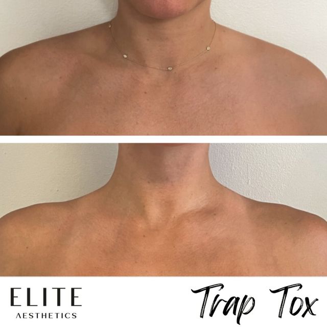 Trap Tox is a game-changer for your neck and shoulders!

These before & after photos show the aesthetic and functional benefits of using neurotoxin treatment in the trapezius muscles of the upper back. 

✨ Aesthetic benefits include elongation of the neck, slimming of the shoulder, and sleeker upper body angles.

✨ Functional benefits include less tension in the neck and shoulders, better posture, and less stiffness/ soreness.

Book now to elevate your body with #TrapTox! 

#barbiebotox #trapezius #shoulderpain #posturecorrection #botoxinjections #neurotoxins