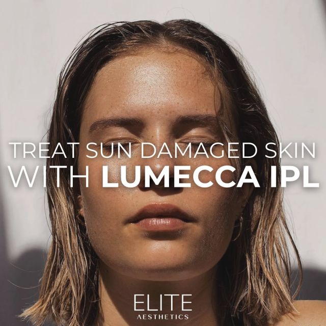 Too much fun in the sun this summer? Unfortunately, your skin might be showing it 👀☀️

Good news? You can erase the results of too much time in the sun with Lumecca - an intense pulsed light (IPL) used to safely and effectively treat sun damage which may appear as brown spots or wrinkles along the face and body.

Call or text +1 (212) 647-1930 or visit our website to learn more  and book your first treatment!

#lumecca #ipl #skintreatment #sundamagedskin #sundamagetreatment