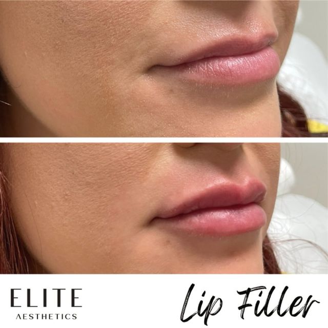 Elevate your lips with our amazing injector Isis!

Isis has over 20 years of experience in aesthetics and specializes in subtle treatments that help you achieve your dream look 👄

Call or text 212-647-1930 to book with Isis!