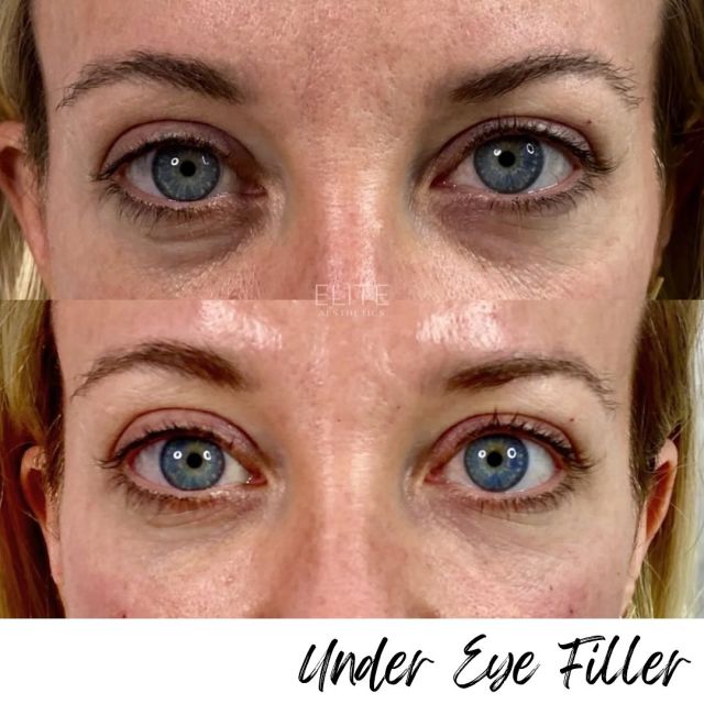 Want to reduce the appearance of dark circles, hollows, and fine lines - giving a more refreshed and youthful look? Try Under Eye Filler 👀✨

Wondering if this treatment is right for you? Under eye filler is good for those in good health who have concerns about under-eye volume loss due to aging or genetics. We always want to keep facial balancing in mind - so individuals with well defined facial features are often better candidates for under eye filler alone. If someone has volume loss across the entire face, we may need to add filler in areas other than the under eye to achieve a more balanced look. 

Our Elite professionals will assess your face to determine the best approach, ensuring that any enhancements complement your unique features 🥰 We’ll help you achieve a refreshed and balanced look!

Book a filler consultation online or call/text 212-647-1930 

#undereyefiller #undereyetreatment #undereyecircles #facialtreatment #fillerinjection #nycmedspa