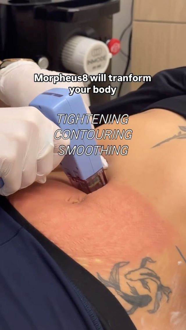 Slim down and smooth out with Morpheus 8 Body 😎

Did you know Morpheus 8 Microneedling RF is not just for the face? You can also get treated on your body including the stomach area, thighs, buttocks, upper arms and other stubborn spots. 

This treatment can trigger deep soft tissue changes and collagen production that improves the shape and smoothness of the body. It can help address loose skin, loss of volume, sun damage, and stretch marks - and even reduce fat!

It’s a great post-baby or post-weight loss treatment that can help contour the body and boost self-confidence ✨

Call/text 212-647-1930 to learn more and start transforming your body today