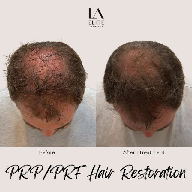 Struggling with thinning hair? PRP and PRF hair restoration treatments harness the power of your own body to naturally promote hair growth and restore thickness!

In this non-surgical and innovative procedure, we use the regenerative properties of one’s own blood to stimulate hair follicles and improve hair health density. 

This client witnessed these amazing results from July to September with just one treatment! He is still on his hair restoration journey at Elite and for optimal hair stimulation, we recommend 3-5 treatments. 

Ready to say goodbye to thinning hair? Book a PRP/PRF hair injection appointment at Elite online or call/text 212-647-1930

#hairtransformation #thinninghair #nycmedspa #hairtreatment #hairgrowth #thinninghairsolution #prphairrestoration #prptreatment #hairgrowth