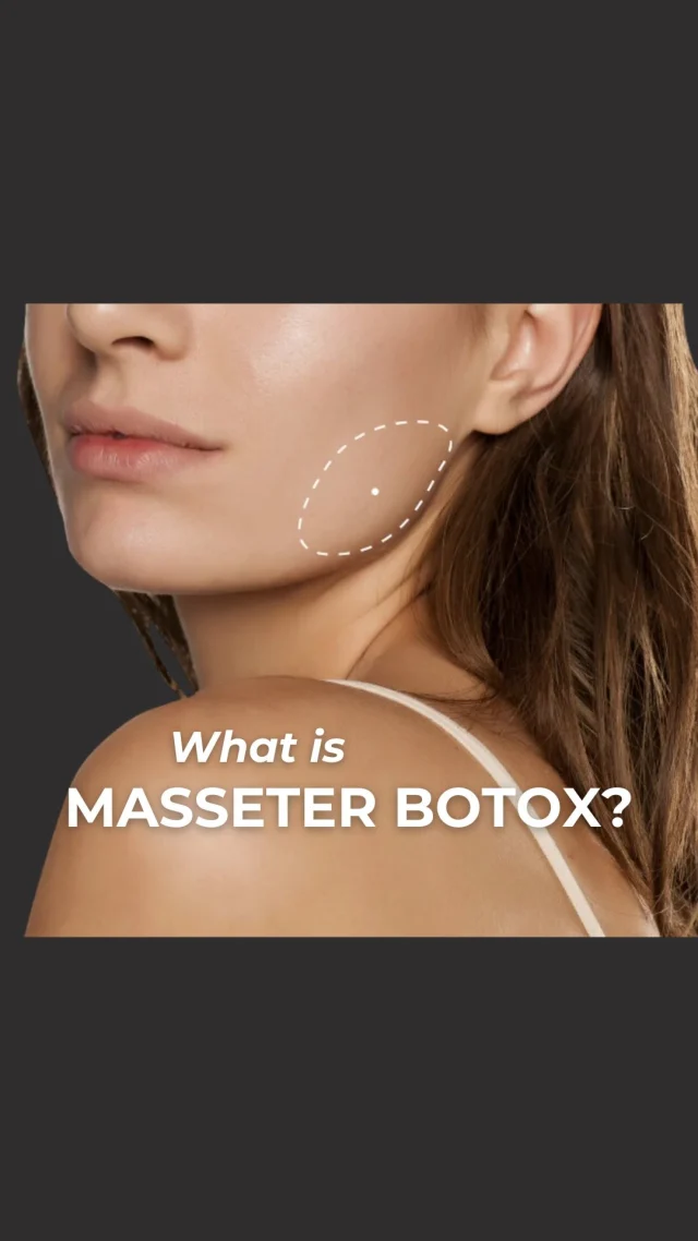 Curious what this “Masseter Botox” is that you keep hearing about?! Let our Elite injector Chelsea breaks it down for you 😌

By injecting Botox into the Masseter muscle, many patients find relief from any pain or discomfort caused by #TMJdisorder, jaw clenching, and teeth grinding. 

PLUS - This treatment also has cosmetic benefits such as creating a slimmer, V-shape appearing jawline! 

While #MasseterBotox has many benefits, we do not recommend it to everyone due to its ability to create jowls. 

Want to know if this treatment is right for you? Book a consultation online today or call/text 212-647-1930!

#neurotoxin #facialtreatment #jawbotox #nycmedspa #jawline #masseter