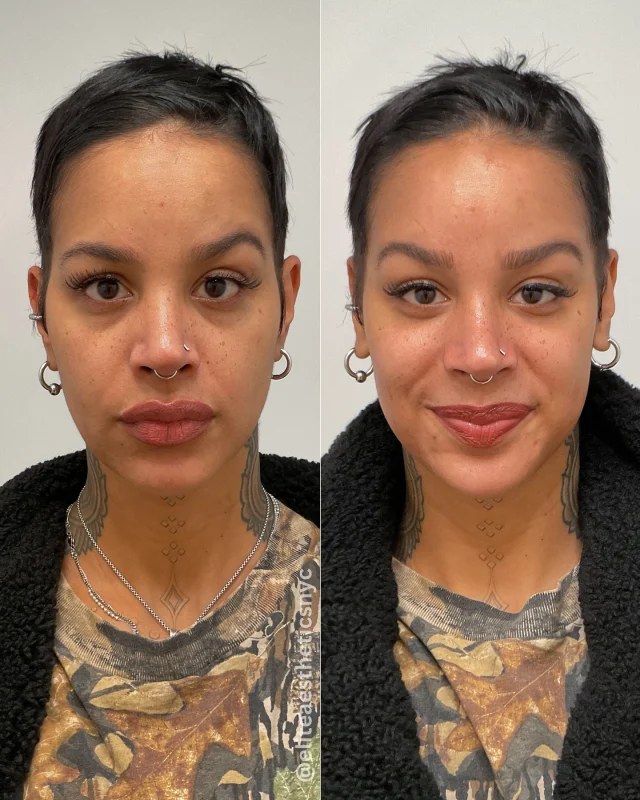 Our favorite afters are the ones with a smile 🥹🥰 This client received a Hydrafacial which included lymphatic drainage and LED light therapy treatment. 

You can see an instant transformation in her skin texture, hydration, puffiness and confidence!

Elevate your winter skin with @hydrafacial 🧖‍♀️ Book online or call/text 212-647-1930 

#hydrafacial #skintreatment #winterskincare #facialtreatment #skincare #nycmedspa