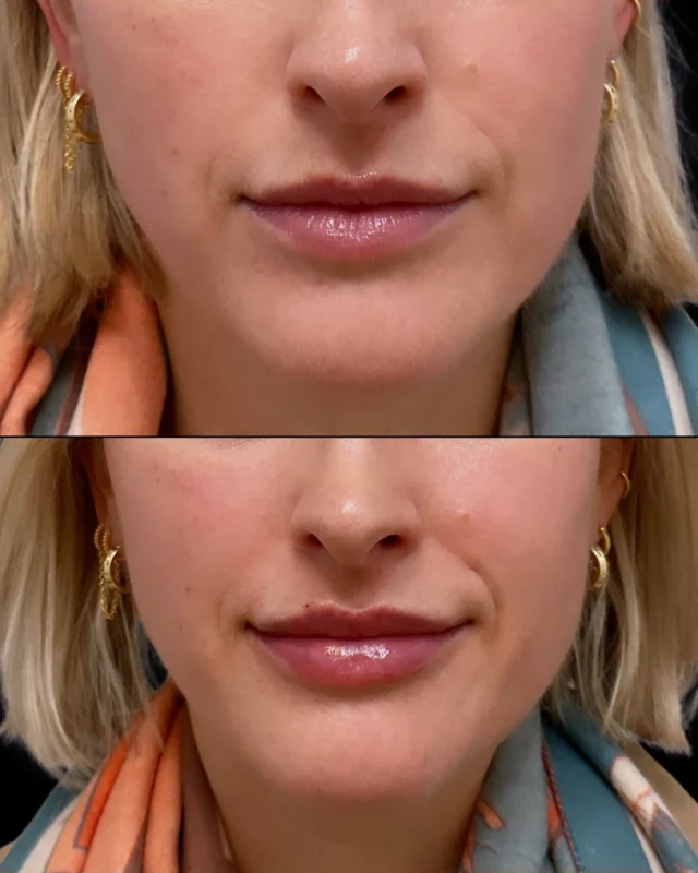 One kiss is all it takes 💋 Valentine’s Day is almost 2 weeks away, so hurry and book your last minute appointments so you’re ready to pucker up! 

With this client, @mariesa_elitenyc did 1 syringe of lip filler to achieve plumper and evened out lips.

Book online or call/text 212-647-1930 to start perfecting your pout 😘

#lipfiller #lipinjections #valentinesday #lipfillers #nycmedspa #perfectpout