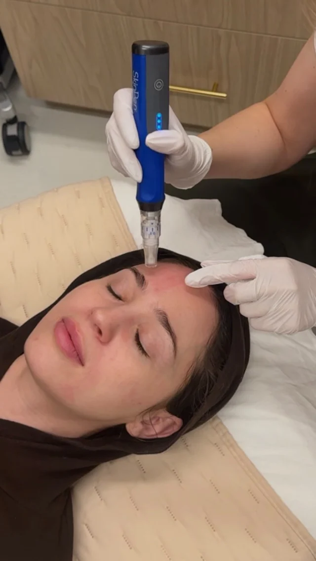 Boost collagen, smooth fine lines, and reveal your natural radiance with PRP and microneedling 😍

Often referenced as a Vampire Facial, this treatment stimulates collagen production by rolling fine needles over the skin with @skinpen and applying platelets, which are taken from one’s own blood. 

Interested in a quick, natural glow up? PRP Microneedling is the treatment for you! Book now.

#prpfacial #prptreatment #facialtreatment #prpmicroneedling #microneedling #nycmedspa