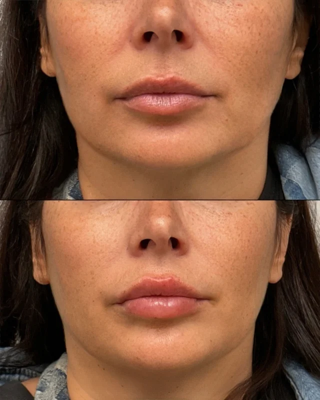 Plump and hydrated ✅ This gorgeous lip filler transformation shows how just the right amount of filler can create a plumper, more even pout. 

Ready to elevate your lips? Book online or call/text 212-647-1930! 

#lipfiller #lipinjections #perfectpout #lipenhancement #nycmedpa