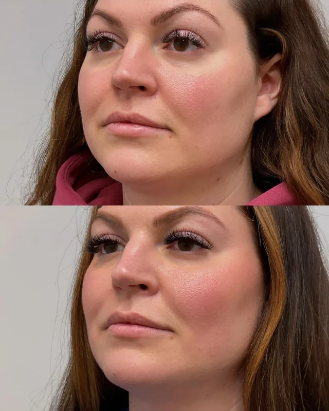 Subtle enhancements, stunning results 💉✨

In addition to botox around the upper and lower face, we also injected filler into the cheek, chin, and jawline for a beautifully balanced, sculpted and lifted look! 

#FacialContouring #NYCMedSpa #ChinFiller #CheekFiller #JawlineFiller #DermalFiller #FacialBalancing #SkincareTreatment