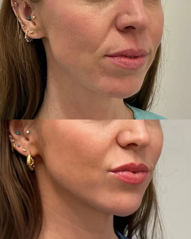 Jawline sculpted, confidence boosted ☑️

This client worked with @mariesa_elitenyc to create a customized treatment plan to achieve a more youthful, balanced look! These beautiful results were achieved through a combination of neurotoxin, biostimulators, and dermal filler over multiple appointments. 

Ready to slim, tighten, and enhance? Book an appointment online or call/text 212-647-1930

#botox #facialtreatment #facialbalancing #nycmedspa #sculptra #biostimulator #dermalfiller #youthfulglow