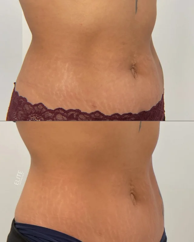Real results. Real confidence. 

We know that the midsection area can be a big insecurity for people… With Morpheus8 Body, you can address stubborn areas - remodeling collagen, improving stretch marks, and tightening loose skin. 

This client saw amazing results after just 3 sessions, leaving with smoother and tighter skin 🔥

Boost your confidence and transform your body by booking online or call/text 212-647-1930

#morpheus8body #morpheus8 #skintighteningtreatment #nycmedspa #bodyconfidence #stretchmarks