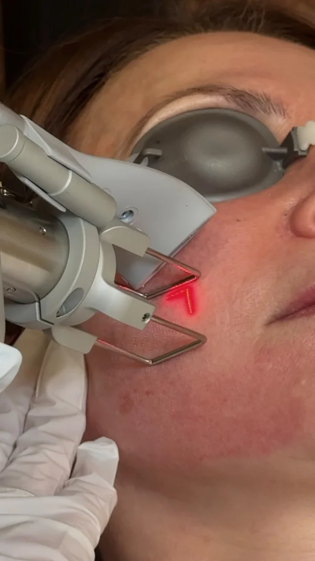 CO2 Laser Treatment is the answer that you’ve been looking for smoother texture, softened lines, and a brighter, tighter glow ✨

A deep refresh for your skin, our CO2 Deka Pro Laser is customizable to target sun damage, scarring, wrinkles, and other signs of aging in one powerful treatment.

This is your last change for laser before summer so start your transformation today 👀 Book online or call/text 212-647-1930 to learn more! 

#co2laser #co2treatment #skinrejuvenation #nycmedspa #lasertreatments #laserco2