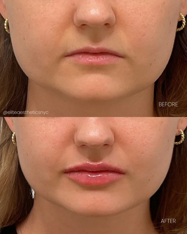 A natural looking plump, tailored to enhance your beauty 💉👄 

Our client left with fuller lips and new found confidence ✨ With just 1 syringe of Restylane Kysse Lip Filler, @mariesa_elitenyc was able to enhance lip shape and fullness all while maintaining a natural balance. 

Get your pout ready for summer💋Book an appointment now! 

#lipfiller #lipinjection #plumppout #nycmedpa #lipinjector #fullerlips