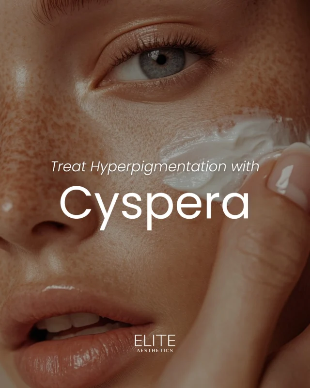 Say goodbye to stubborn pigmentation with Cyspera ✨

Discover the magic of Cyspera, now available at Elite Aesthetics. This safe, gentle, and effective treatment works to treat discoloration on all skin tones and types!

Visit our Flatiron location to bring home your Cyspera Pigment Correction System or book a consultation to have an expert tailor a plan for your unique skin needs 🥰

#cyspera #hyperpigmentation #skintreatment